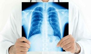 ​​​​​​​Tuberculosis, una enfermedad antigua