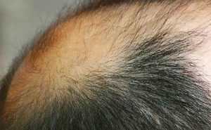 Descubren fármaco efectivo contra la alopecia