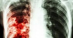 Tuberculosis, la enfermedad infecciosa más letal