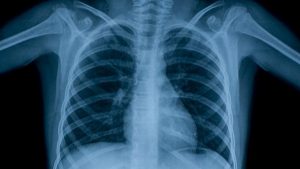 Crece tuberculosis 107% en Tabasco, la del tipo respiratoria es la más común