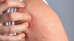 Dermatitis atópica puede afectar rendimiento laboral: Especialista