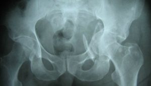 Dos millones de mexicanas padecen osteoporosis: Especialista