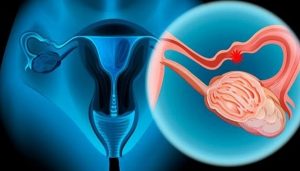 Estos son los síntomas de cáncer de ovario que las mujeres podrían estar ignorando