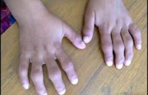 ¿Qué es la artritis idiopática juvenil?
