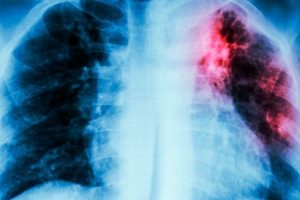 Lo que debes saber acerca de la tuberculosis