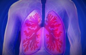 ¿Qué es la bronquiectasia y cuáles son sus síntomas?
