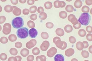 La leucemia mieloide, enfermedad que afecta a cinco mil jóvenes al año