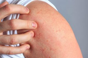 ¿Qué es la dermatitis por estasis?