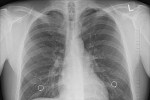 Pacientes asintomáticos de COVID-19 también sufren daño pulmonar: Estudio