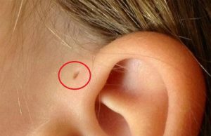 ¿Qué es el pequeño agujero en la oreja que tienen algunas personas?