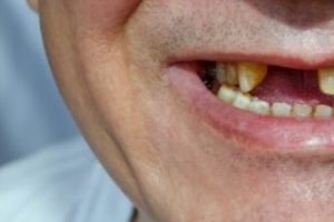 Caída de dientes, entre los nuevos efectos tras padecer de COVID-19