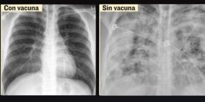 Vacuna contra Covid 19 podría evitar daño grave en pulmones tras contagio