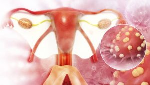Estos factores podrían provocar el cáncer de ovario