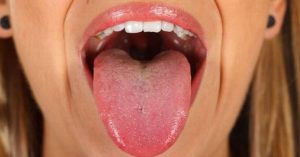 Paciente desarrolla extraña enfermedad; se le puso la lengua negra y le salió pelo
