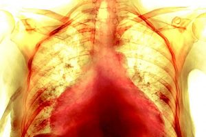 Especialistas advierten inflamación del corazón en pacientes COVID-19