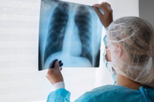 México registra más de 7.500 nuevos casos de cáncer de pulmón cada año: OMS