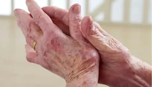 Vinculan el lupus con un virus que casi todos los humanos portan