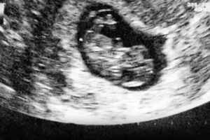 Exposición prenatal al calor húmedo extremo frena crecimiento de los niños: Estudio