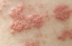 Conoce el herpes zoster y cómo se contagia