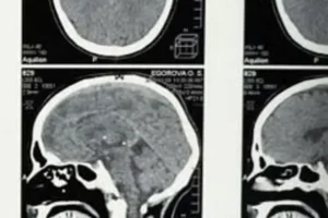 Un cerebro más distraído podría ser más creativo, revela investigación