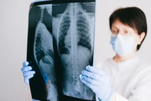 ¿Qué es un nódulo pulmonar y qué tan peligroso puede ser?